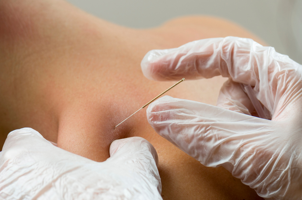 Closeup of dry needling.